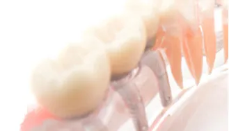 インプラントについて