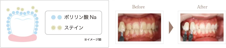 ポリリンホワイトニング